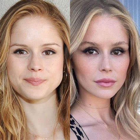 Erin Moriarty Before and After Plastic Surgery Journey。